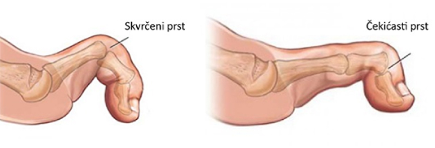 skvrčeni i čekićasti prst
